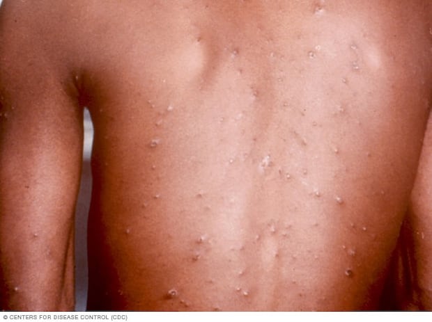 Cuando tengas varicela, te aparecerá un sarpullido que produce picor principalmente en la cara, el cuero cabelludo, el pecho y la espalda, y también te saldrán ampollas en los brazos y las piernas. (Fuente: Mayo Clinic)