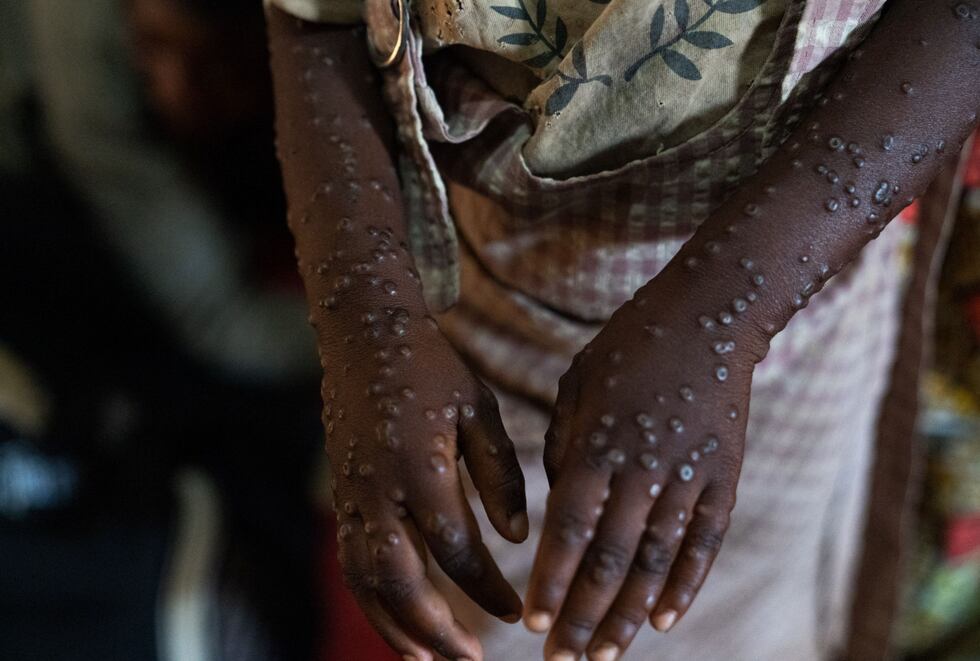 Un paciente con una forma grave de la epidemia de mpox es tratado en el hospital de Kavumu, en el Congo, el 24 de agosto de 2024 (Foto: Glody Murhabazi / AFP)