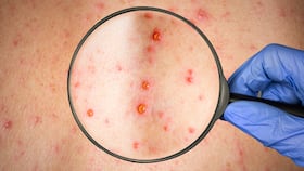 A pesar de tener síntomas similares, el sarampión y la varicela son infecciones completamente distintas con orígenes y tratamientos diferentes.